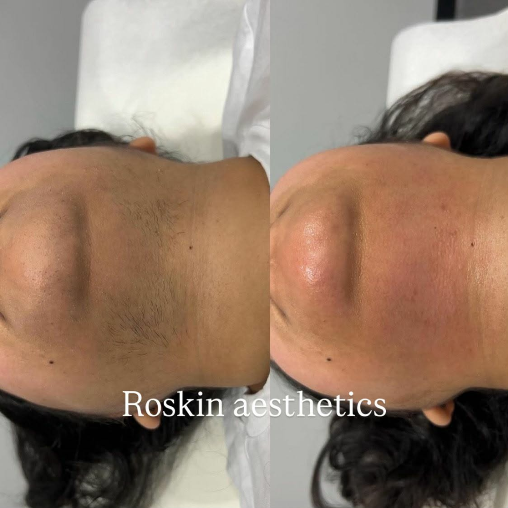 Résultat Avant Après 1