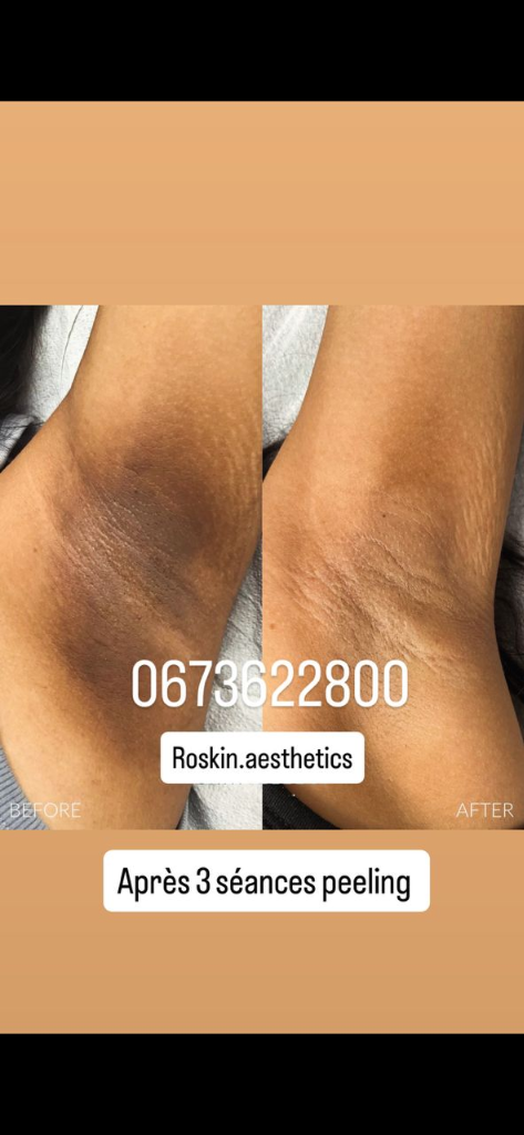 Résultat Avant Après 3