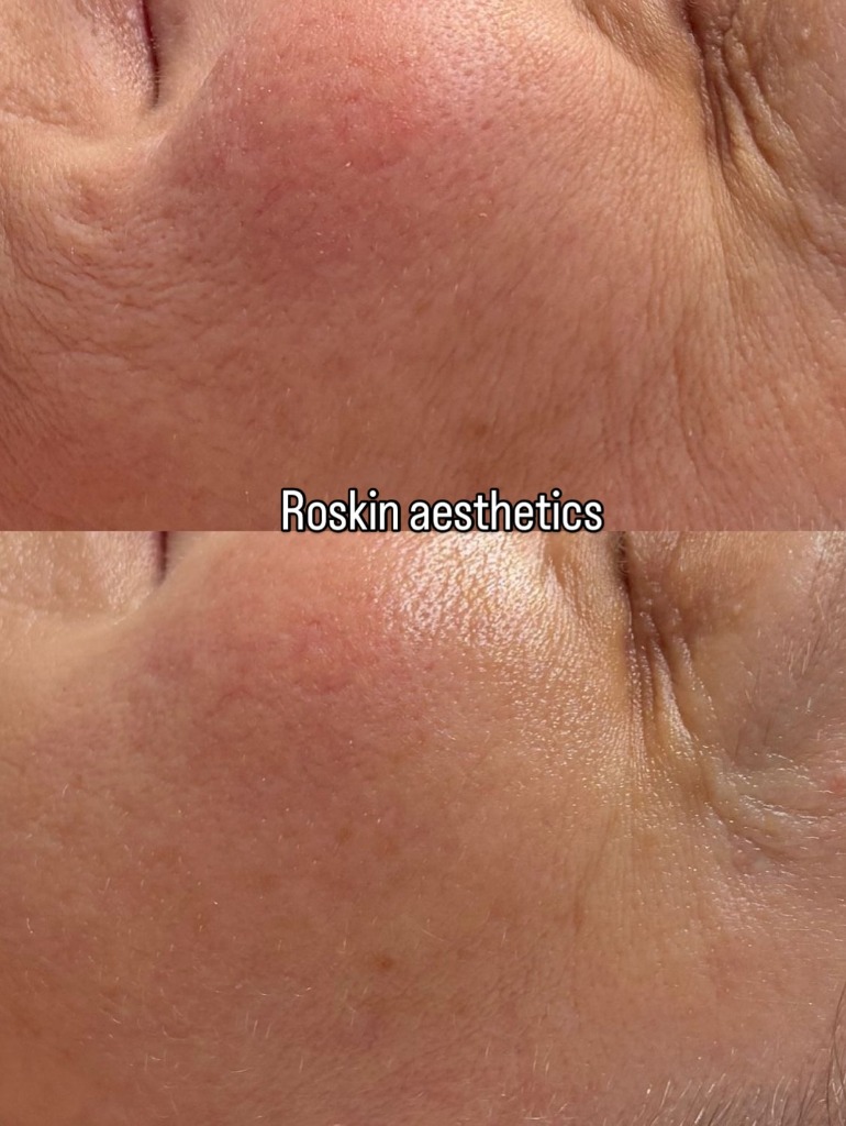 Résultat Avant Après 4