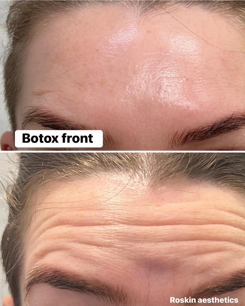 Résultat Avant Après 5